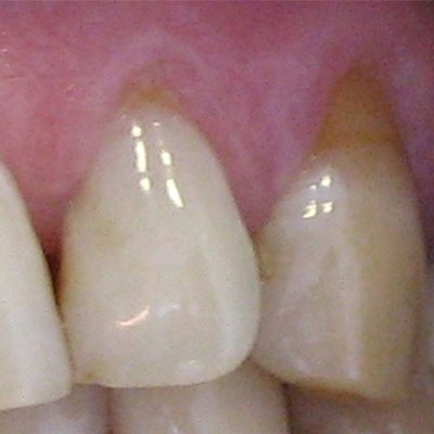 До лечения